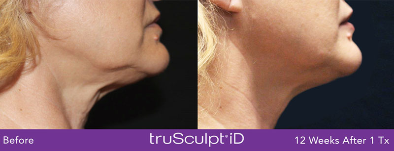 chin contouring
